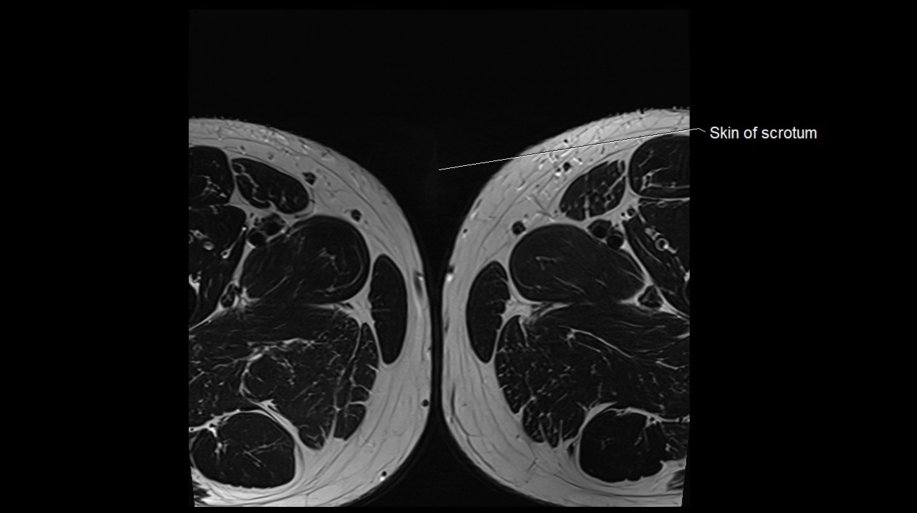 MRI 3T scrotum and penis axial cross sectional anatomy image 43.webp